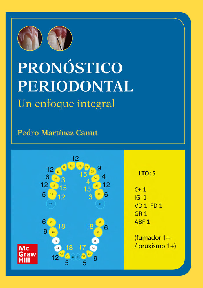Pronostico periodontal (POD)